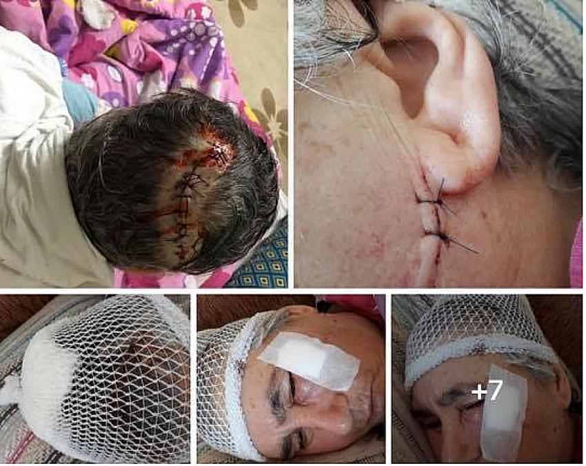 Tefenni'de Yaşlı Kadına Pitbul Saldırdı Ölümden Döndü